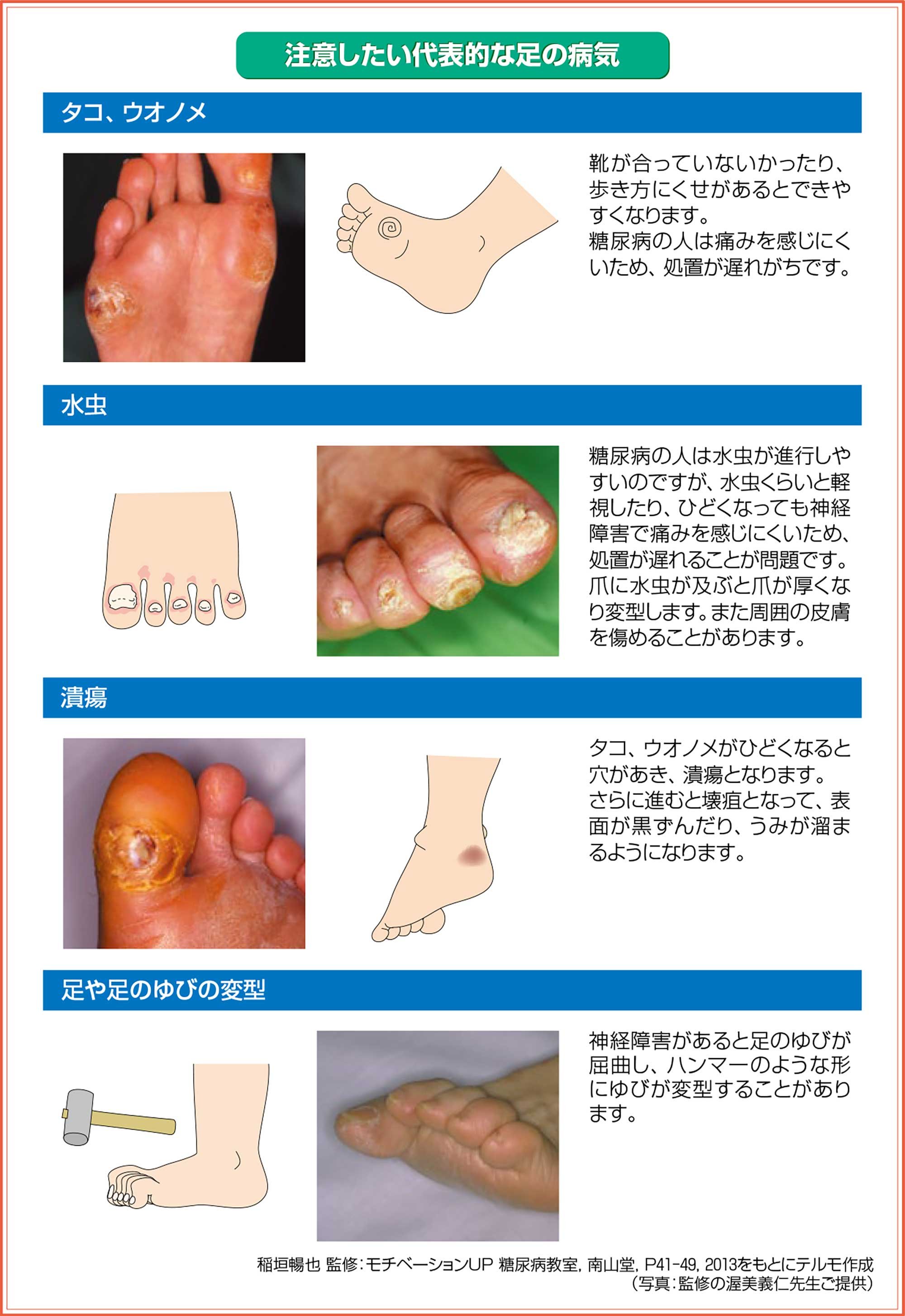 注意したい足の病気は、①タコ、ウオノメ、イボ　②水虫　③潰瘍　④足や足の指の変形　です。