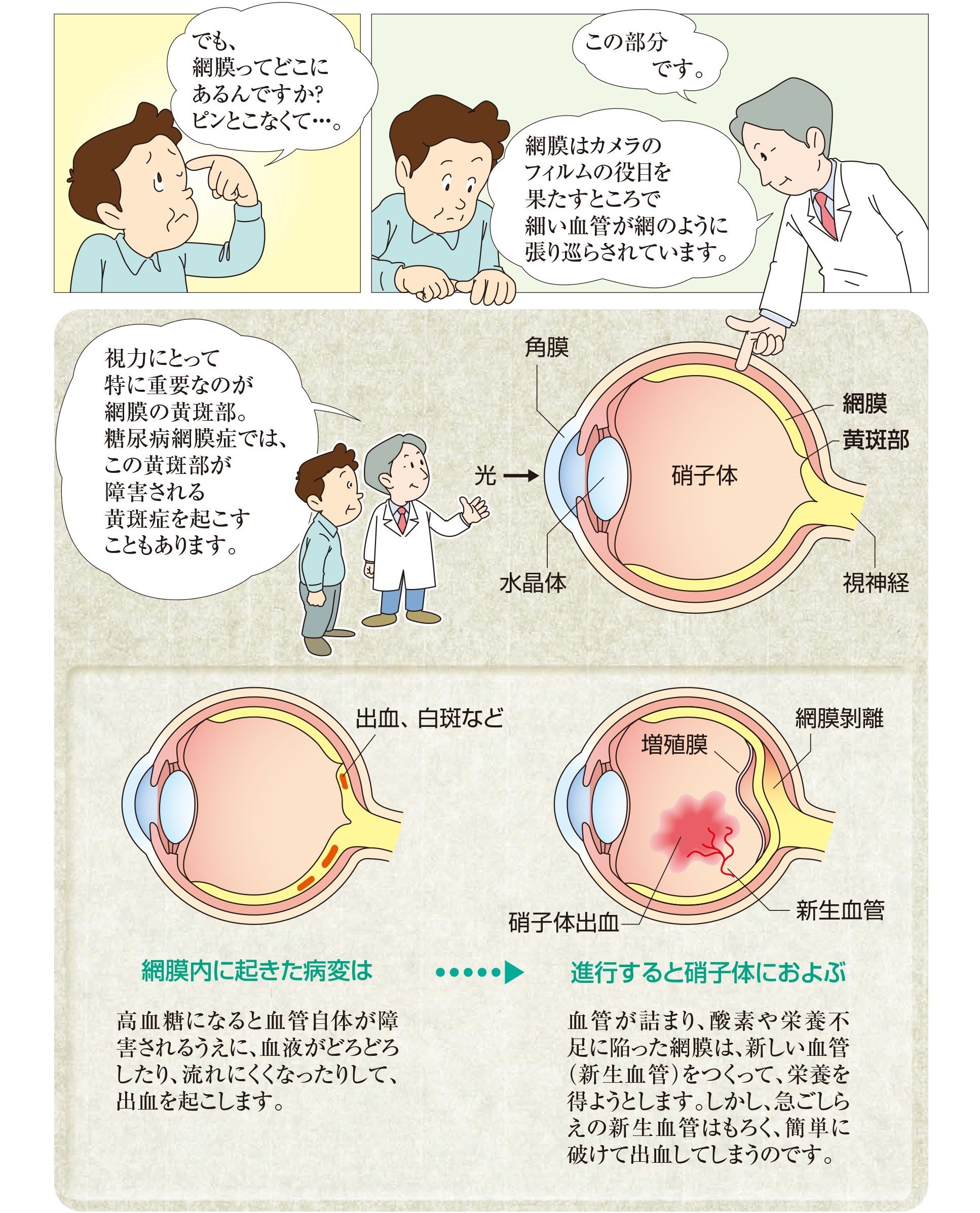 高血糖になると血管が障害され、網膜内に出血などが起こりやすくなります。進行すると、硝子体内出血を引き起こすリスクがあります。