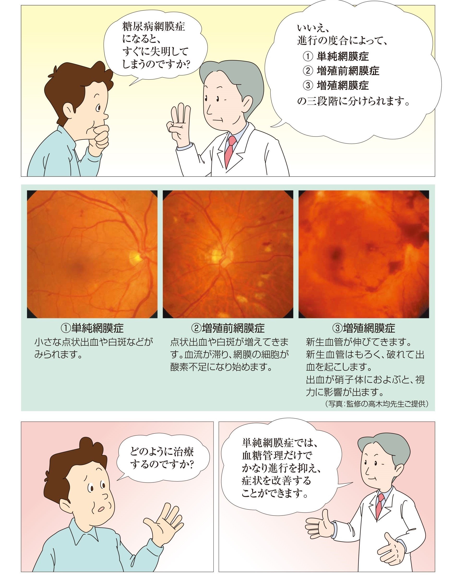 進行の度合いによって三段階に分けられます。①単純網膜症　②増殖前網膜症　③増殖網膜症